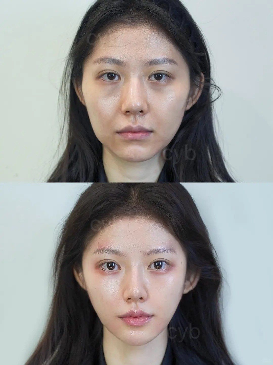 35岁苹果肌提升前后