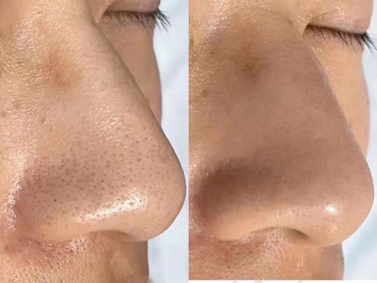 黑头前后对比,真的太干净了!这家宝藏店你一定要去!