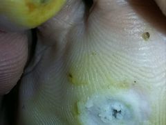 -祖传修脚甲沟炎灰指甲鸡眼