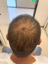 点击看大图 -大麦微针植发丨全国连锁