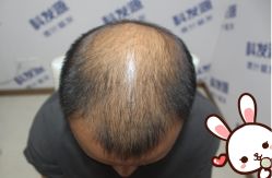 -大麦微针植发丨全国连锁