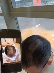 -碧莲盛·不剃发植发