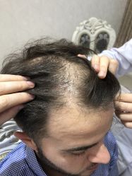 -大麦微针植发丨全国连锁