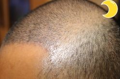 -大麦微针植发丨全国连锁