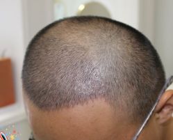 -大麦微针植发丨全国连锁