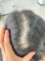 -大麦微针植发丨全国连锁