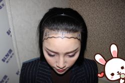 点击看大图 -大麦微针植发丨全国连锁