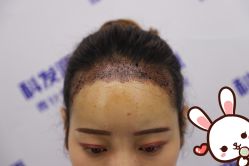 点击看大图 -大麦微针植发丨全国连锁