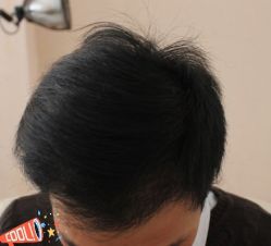 -大麦微针植发丨全国连锁