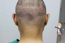 -大麦微针植发丨全国连锁