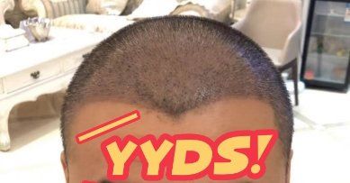 -大麦微针植发丨全国连锁