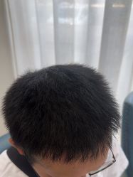 -大麦微针植发丨全国连锁
