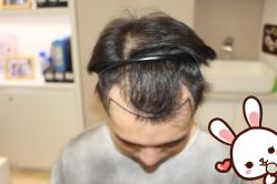 点击看大图 -大麦微针植发丨全国连锁