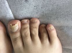 -德哥灰指甲脚气甲沟炎跖疣护理