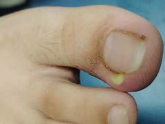 -祖传修脚甲沟炎灰指甲鸡眼