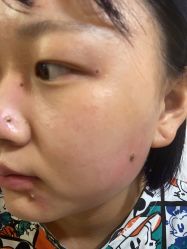 体验前-北京美痣堂古方祛痣斑疣瘊