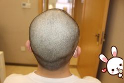 -大麦微针植发丨全国连锁