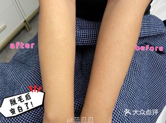 厦门美容｜永久脱毛｜多琳