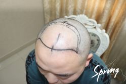 -大麦微针植发全国连锁