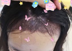 -大麦微针植发全国连锁