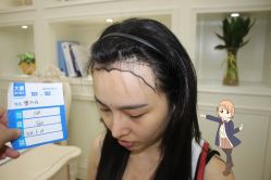 -大麦微针植发丨全国连锁