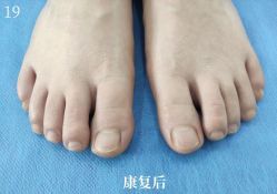 -德哥灰指甲脚气甲沟炎跖疣护理