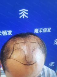 体验前-雍禾植发全国连锁