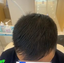 -大麦微针植发丨全国连锁