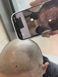 -碧莲盛·不剃发植发