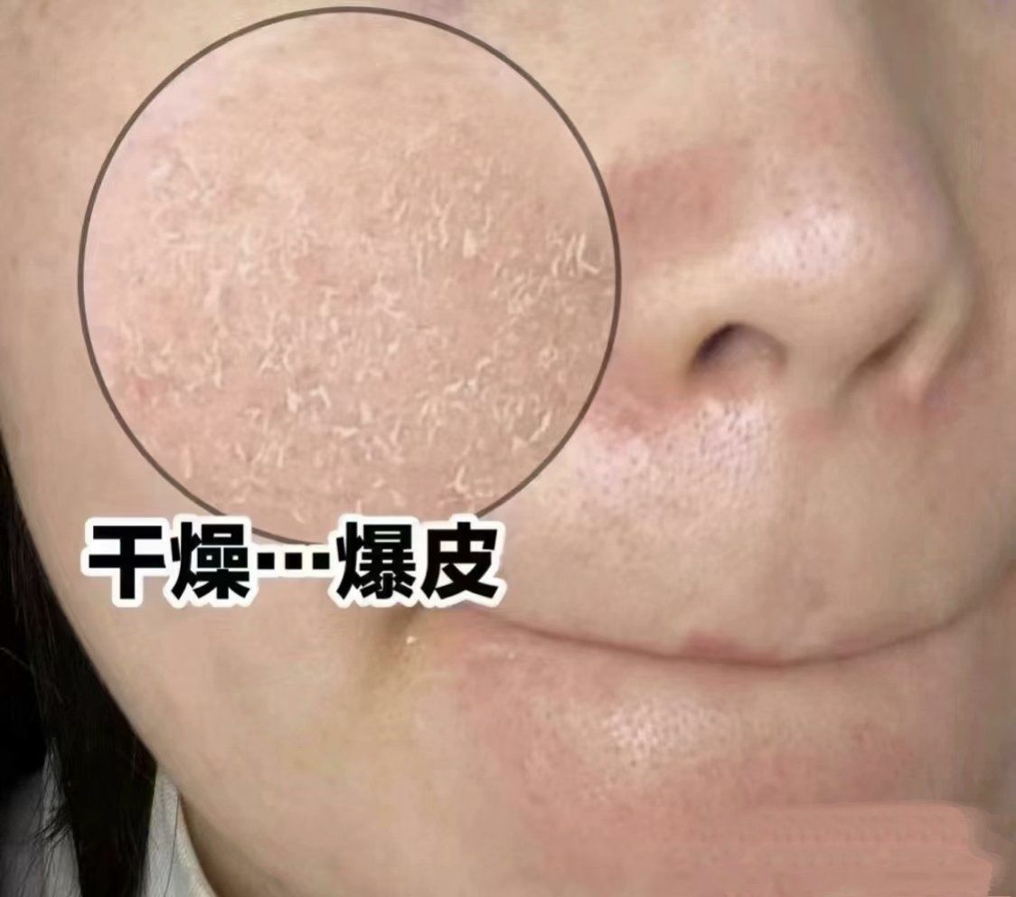 为什么秋冬天皮肤容易干燥起皮!
