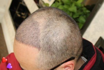 -大麦微针植发丨全国连锁