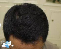 -大麦微针植发丨全国连锁