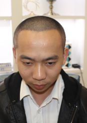 -大麦微针植发全国连锁