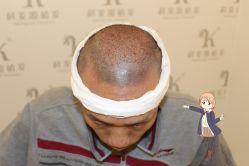 -大麦微针植发丨全国连锁