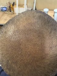 -碧莲盛·不剃发植发