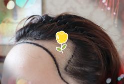 -大麦微针植发全国连锁