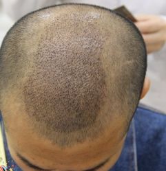 -大麦微针植发丨全国连锁