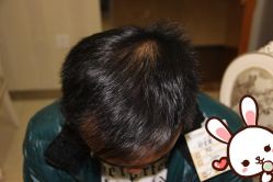 点击看大图 -大麦微针植发丨全国连锁