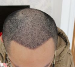 -大麦微针植发丨全国连锁