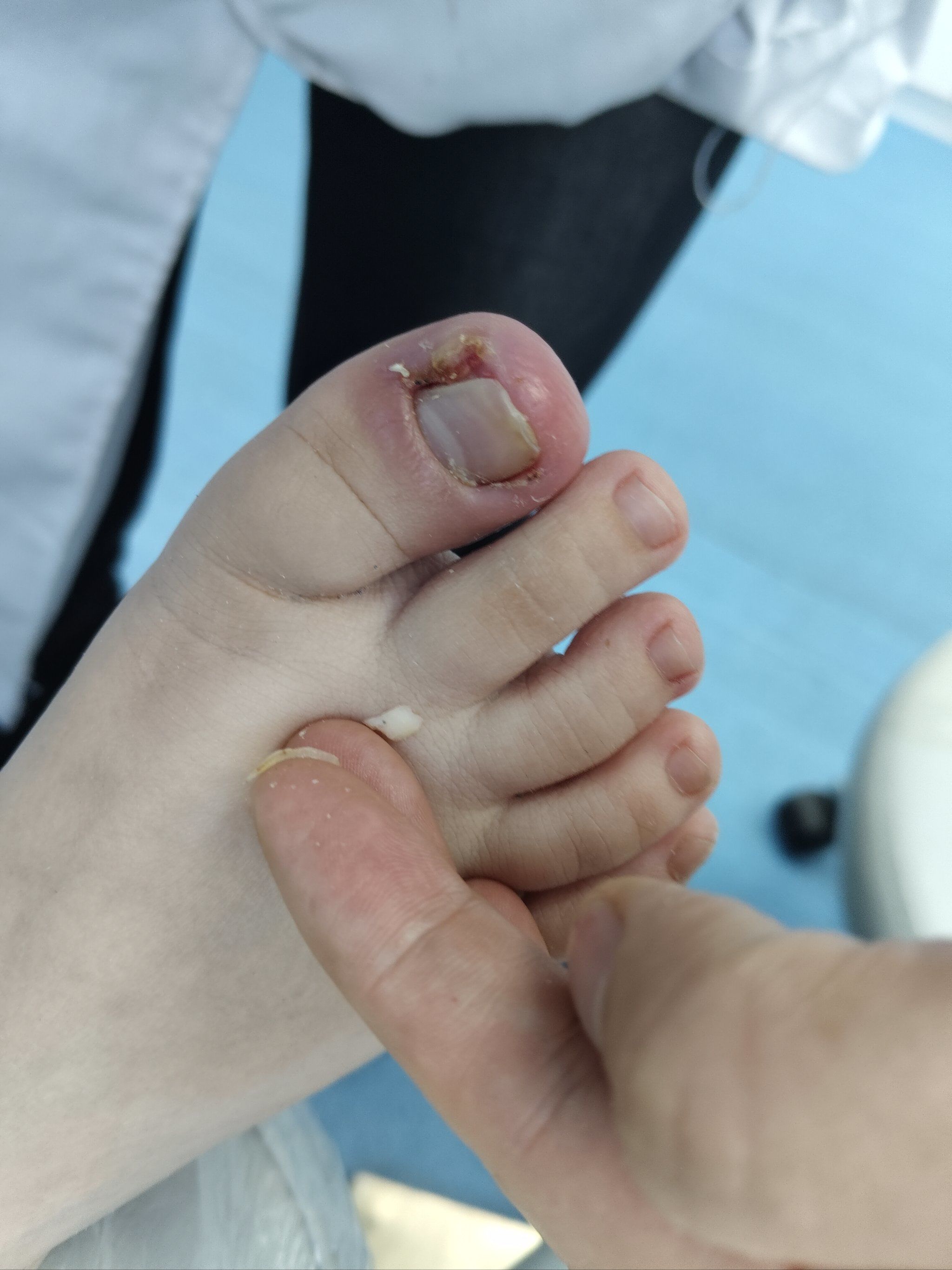 脚指甲往肉里长怎么办#甲沟炎不痛不出血修掉你的扎肉的指甲