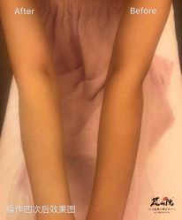 -觅屿日式脱毛美肤