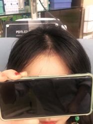 -碧莲盛·不剃发植发
