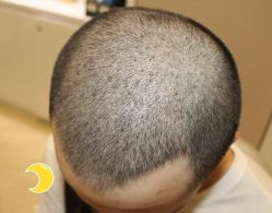 -大麦微针植发丨全国连锁