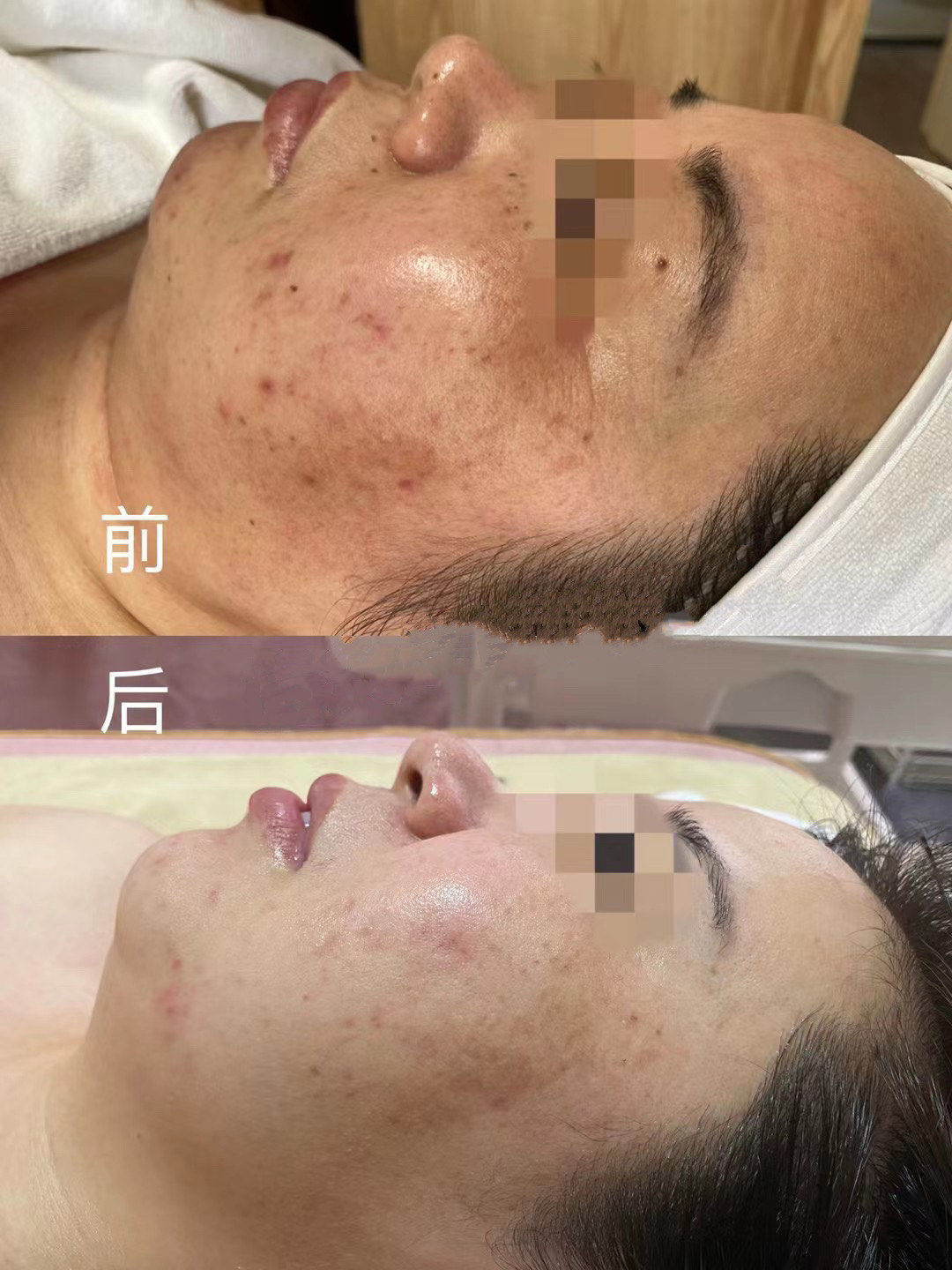 美国科医人m22黄金超光子专业解决问题性肌肤