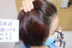 -大麦微针植发丨全国连锁