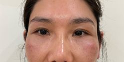 -广州健丽·去眼袋医疗美容机构