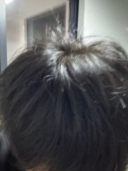 -大麦微针植发丨全国连锁