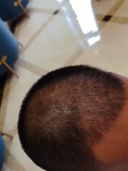 -碧莲盛·不剃发植发