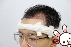 点击看大图 -大麦微针植发丨全国连锁