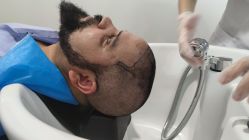 -大麦微针植发全国连锁